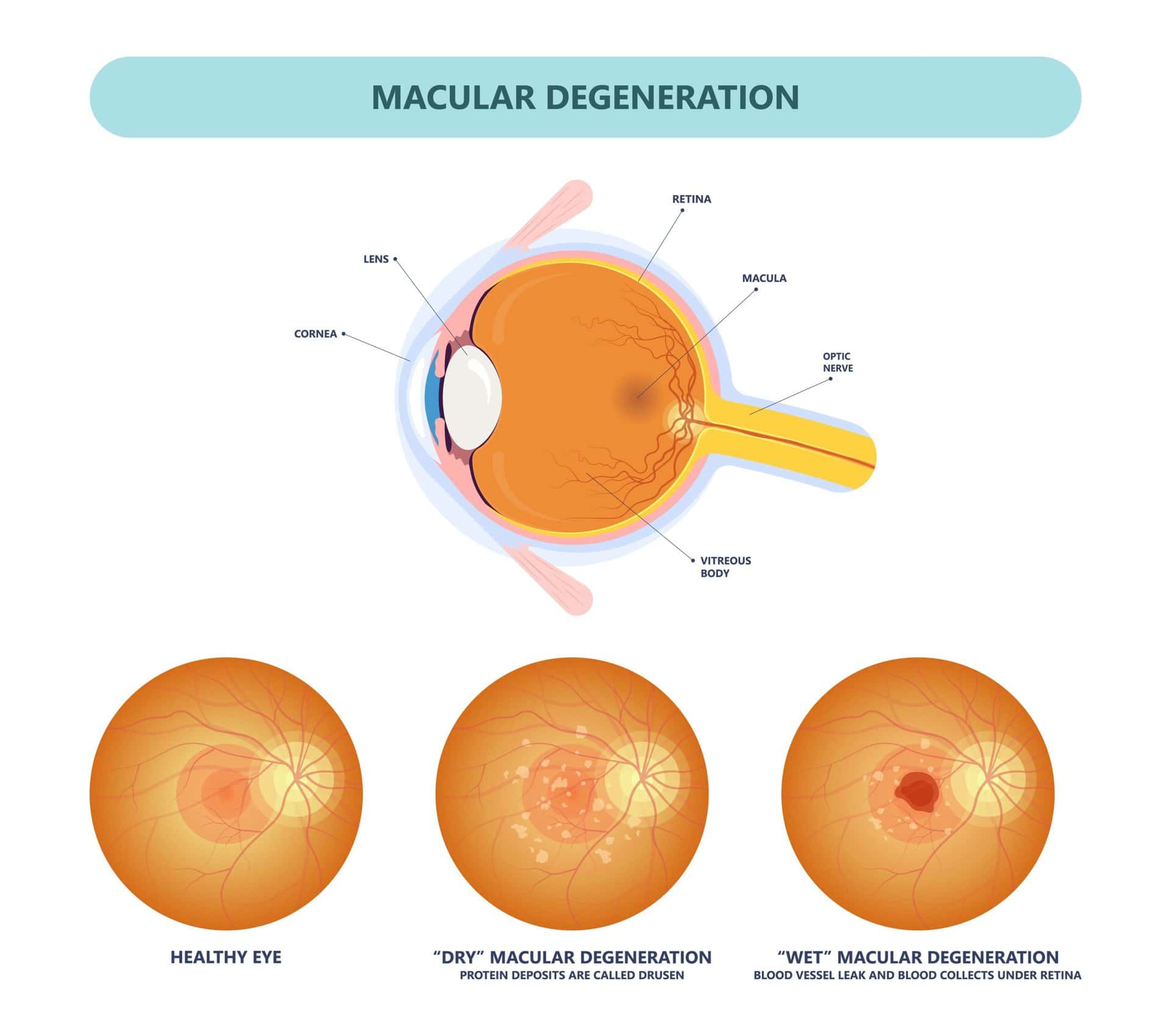 Age-Related Macular Degeneration Symptoms and Treatment - Clinique ...