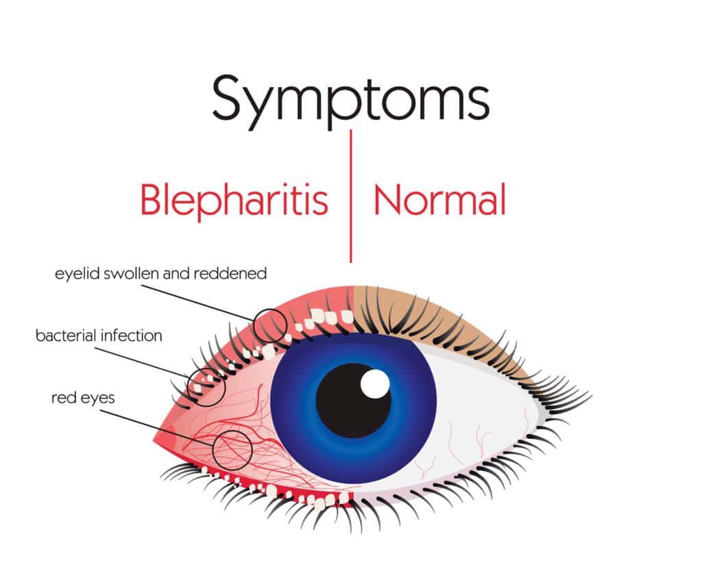 Blepharitis Symptoms And Treatment Clinique VisionPros