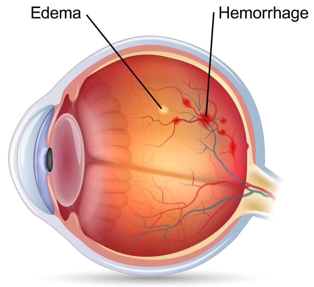 Condition - Vascular Occlusions - Clinique VisionPros
